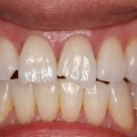Composite Build Up